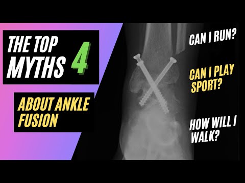 What Can I Do After an Ankle Fusion: 4 Myths About Ankle Fusion