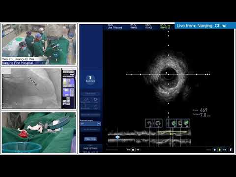 IVUS-Guided PCI and Single Stent of LM Bifurcation Lesion
