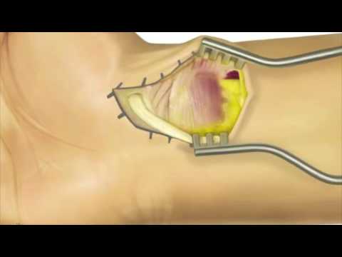 VOLAR SCAPHOID APPROACH