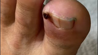 Ep_8658 Ingrown toenail removal 👣 ประโยชน์ของการแช่น้ำ..คืออะไรครับ  🙂 (clip from Thailand)
