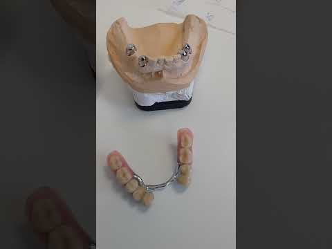 Teleskopprothesen - super Passung und Ästhetik - fest zubeißen trotz herausnehmbaren Zahnersatz