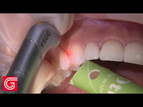 Anterior Gingivectomy for Veneers Teeth #7 - #10 