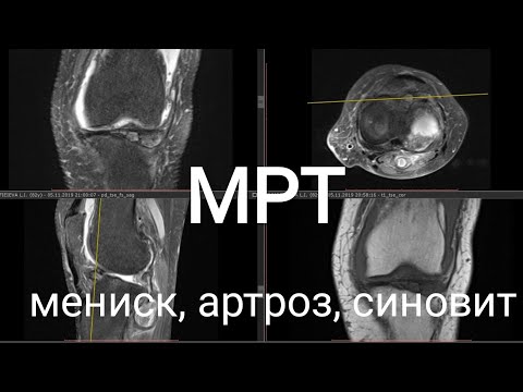 МРТ колена при повреждении мениска, хряща, жидкости в суставе. Врач после операции объясняет