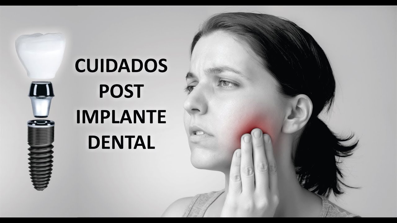 Watch QUÉ CUIDADOS DEBES TENER LUEGO DE COLOCARTE UN IMPLANTE DENTAL Now QUÉ CUIDADOS DEBES TENER LUEGO DE COLOCARTE UN IMPLANTE DENTAL