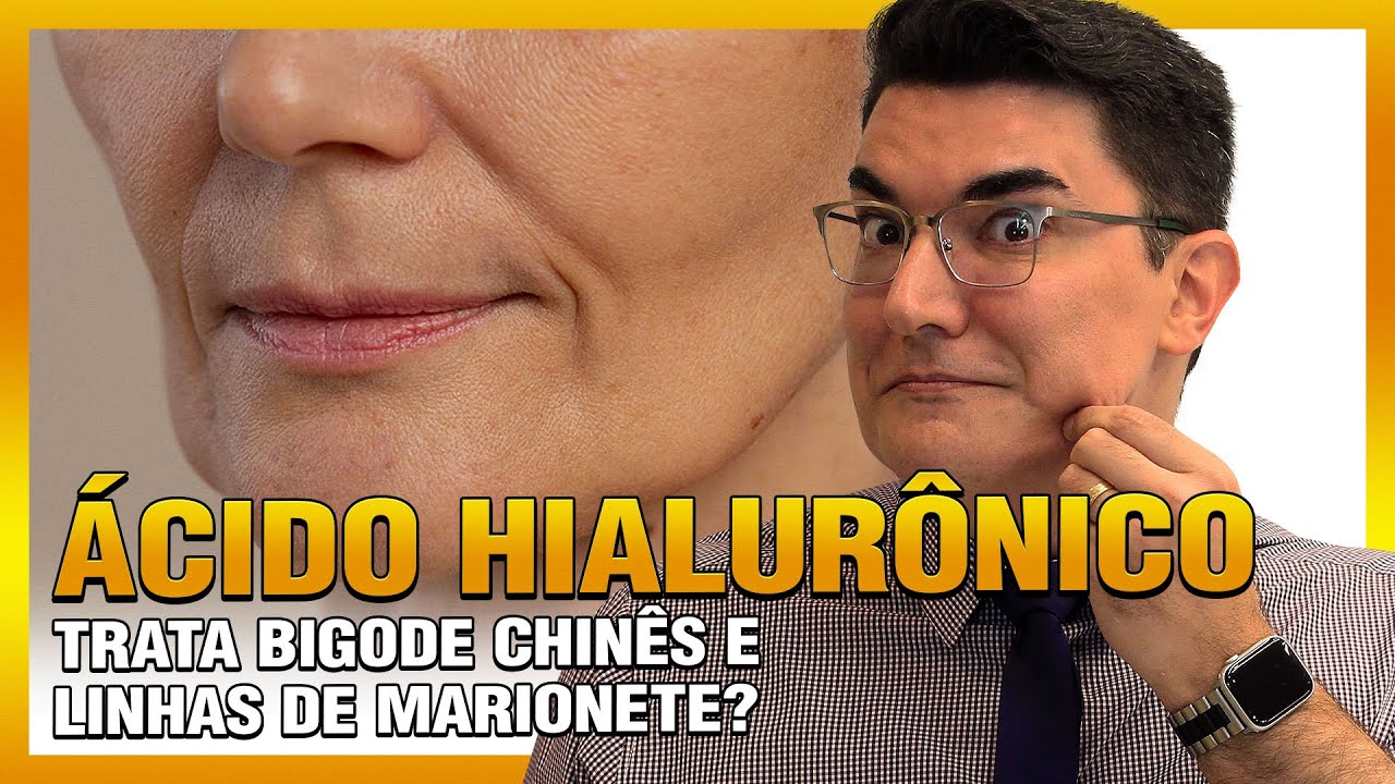 ÁCIDO HIALURÔNICO trata bigode chinês e linhas de marionete?