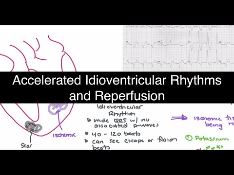 Accelerated Idioventricular Rhythms and Reperfusion