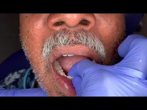 suction effective denture