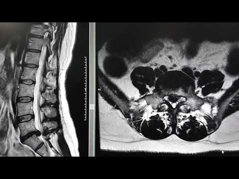 Como se ve una hernia discal en una resonancia.Hernia discal L5-S1.