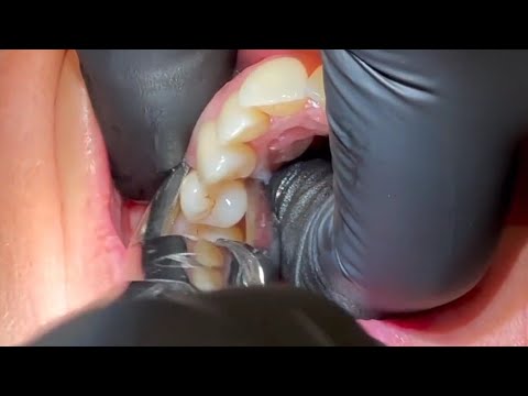 Premolar's Extraction For Orthodontic treatment