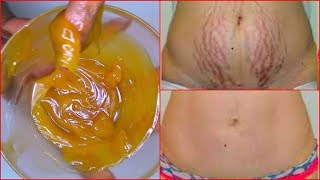 REMOVE STRETCH MARKS FAST, HOW TO GET RID OF STRETCH MARKS EFFECTIVELY | Khichi Beauty