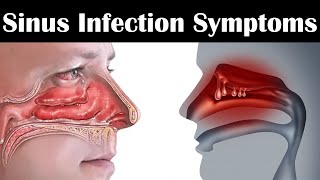 14 Sinus Infection Symptoms that You Should not Ignore