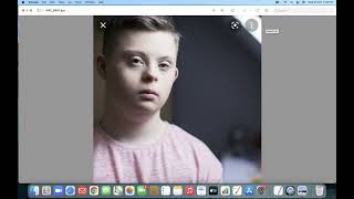MRCPCH - 152. CVS EXAMINATION-Eisenmenger syndrome, VACTERAL , VSD.