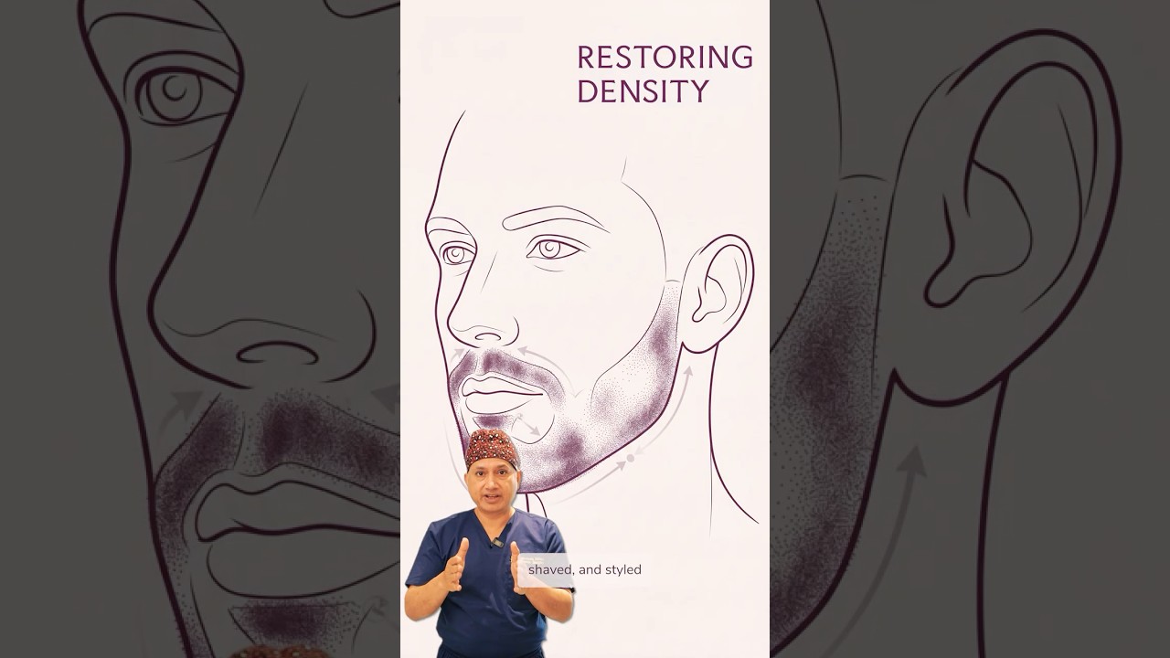 ⏱️ Beard Transplant Explained in 30 Seconds