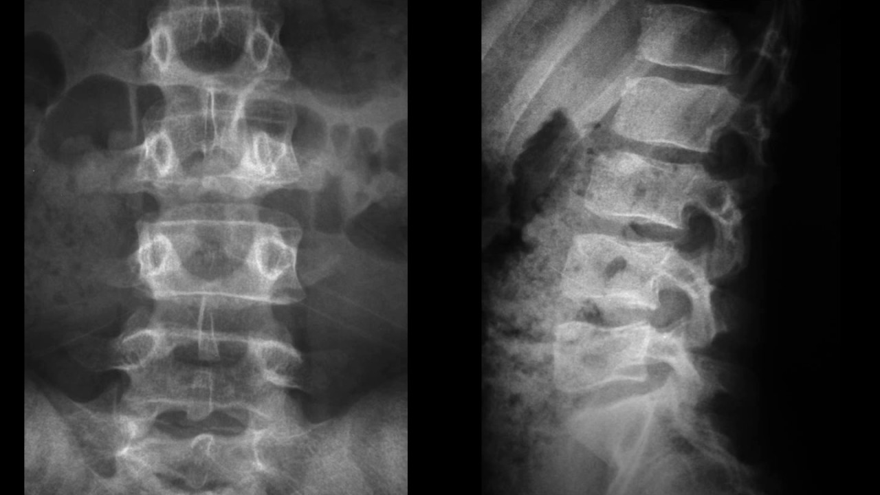 Watch DxI y Dolor lumbar Now DxI y Dolor lumbar
