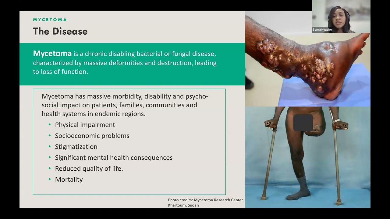 19th Mycetoma Research Club: Mycetoma: A Unique Neglected Tropical Disease