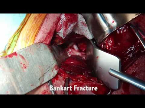 Procedimiento Latarjet | Tratamiento de la inestabilidad del hombro | Cirujano de hombro