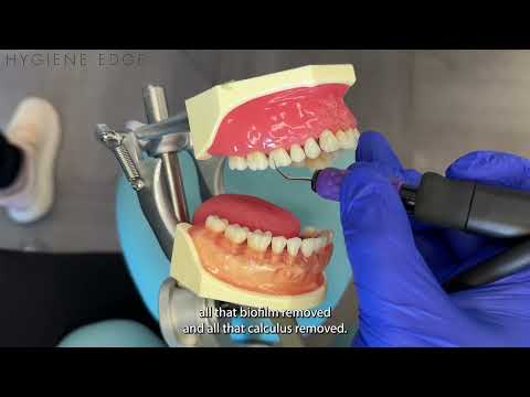 How to Channel with an Ultrasonic Tip Featuring Nordent LuxPoint