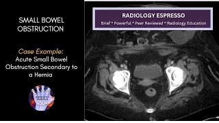 SMALL BOWEL OBSTRUCTION: Case Example – Acute Small Bowel Obstruction Secondary to a Hernia (4250)