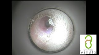 耳掃除動画vol.4「2ヶ月ぶりの耳掃除」