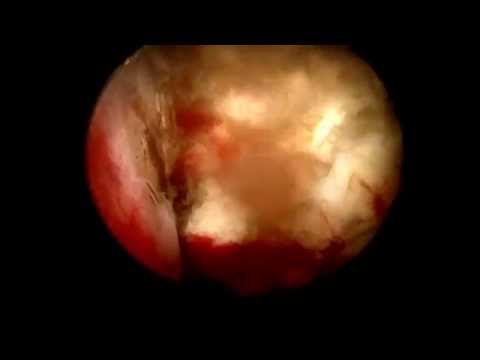 Si rimuove linfiammazione della ghiandola prostatica Apparecchio maestro da prostatite