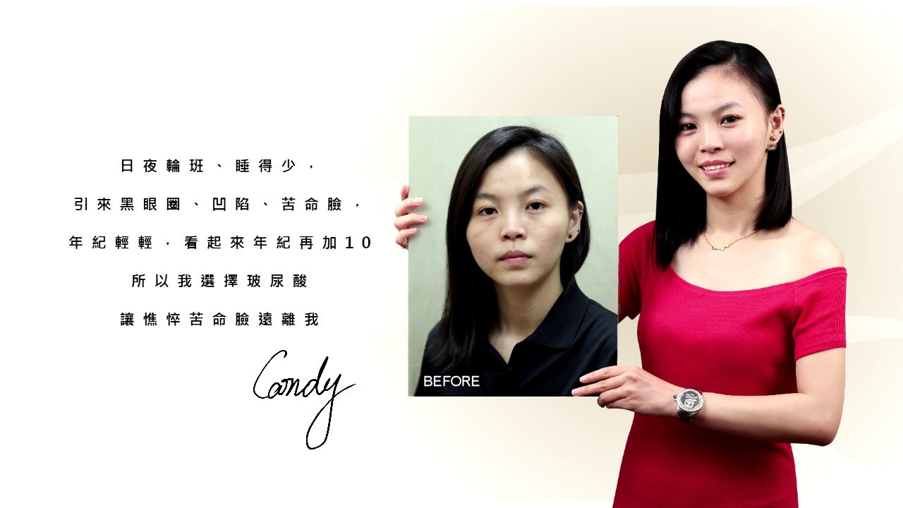iSkin 盧靜怡皮膚專科診所【玻尿酸之見證及評價】好命臉養成計畫_Candy
