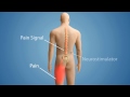 Spinal Cord Stimulator Video