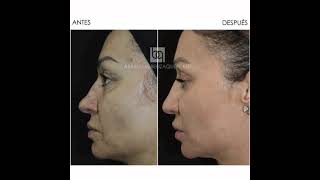 Embellecer nariz sin cirugía. CLÍNICAS BENZAQUÉN (MÁLAGA - MARBELLA - MADRID)