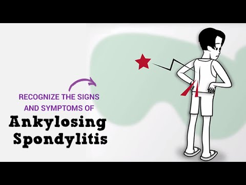 Ankylosing Spondylitis Overview