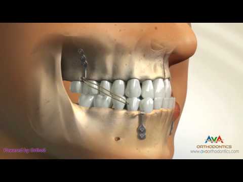 Orthodontic Treatment for Underbite or Crossbite - Bone Anchored Maxillary Protraction