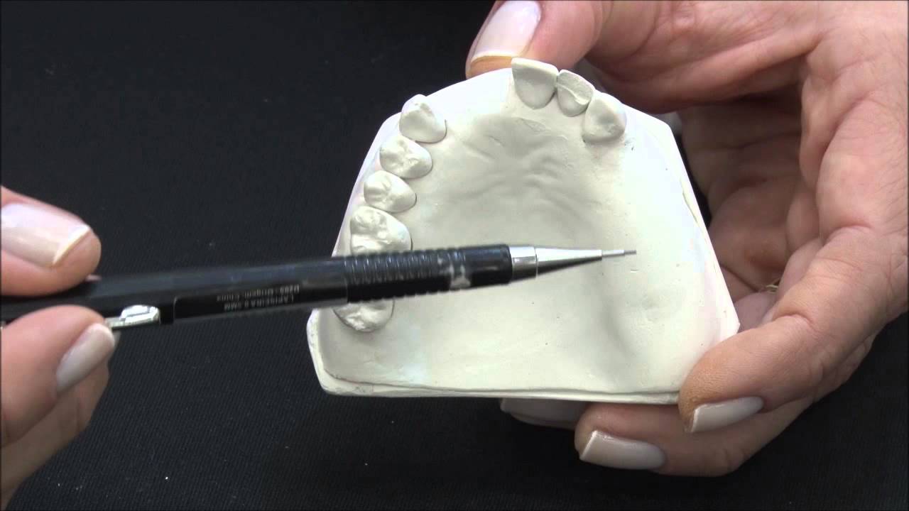 Classificação dos arcos parcialmente desdentados em PPR