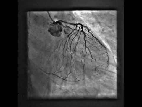 complex multi vessel PCI.