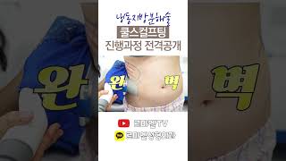쿨스컬프팅 성형 시술