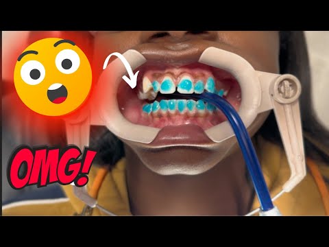 HOW BRACES ARE PUT ON‼️(LIGHTFORCE)-Shullman Orthodontics Wellington, Florida