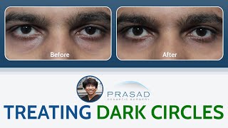 Treating Under Eye Dark Circles