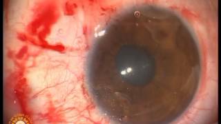 Suturless pterygium surgeyi