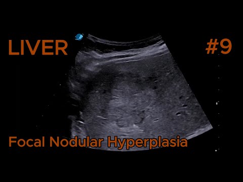 Focal nodular hyperplasia - Isoechoic video preview
