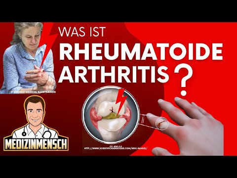 Rheumatoide Arthritis (deutsch) — Rheumatologe erklärt RHEUMA
