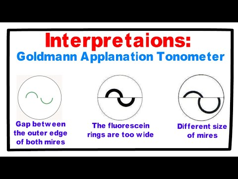 Interpretations- Goldmann Applanation Tonometer.