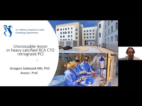 Uncrossable Lesion in Heavy Calcified RCA CTO Retrograde PCI