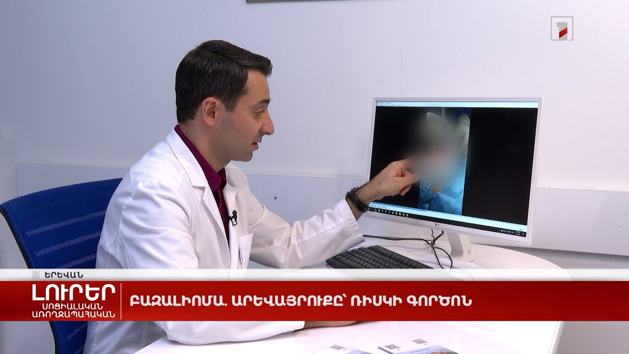 Բազալիոմա. արևայրուքը՝ ռիսկի գործոն