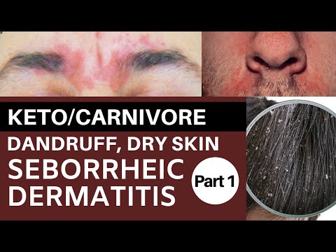 Keto/Carnivore Dandruff, Dry Skin & Seborrheic Dermatitis Part 1: Riboflavin Deficiency