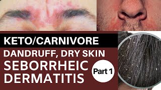 Keto/Carnivore Dandruff, Dry Skin & Seborrheic Dermatitis Part 1: Riboflavin Deficiency