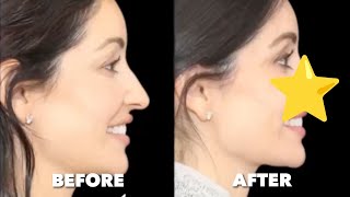 1 Year Post Rhinoplasty: Your Questions Answered