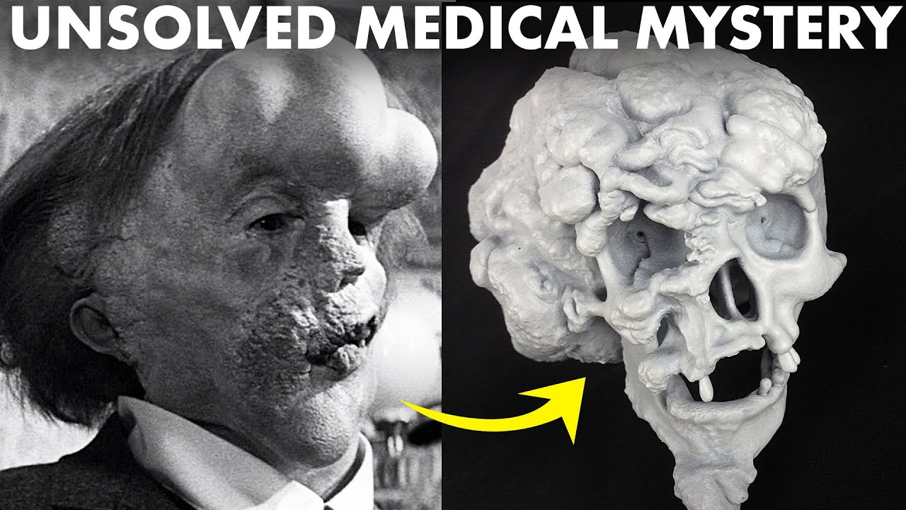 How the Elephant Man Defied ALL Medical Knowledge