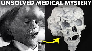 How the Elephant Man Defied ALL Medical Knowledge