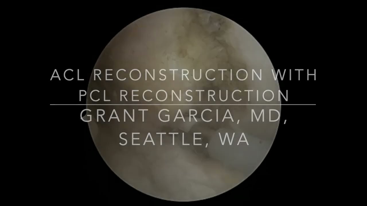 Dr. Garcia’s technique for Combined ACL and PCL reconstruction