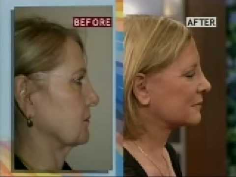 Video testimonials of female revision rhinoplasty patient