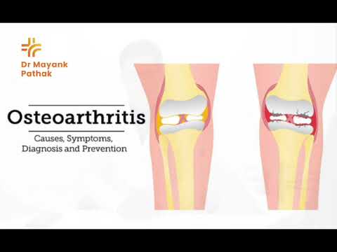 Understanding Osteoarthritis | Dr. Mayank Pathak