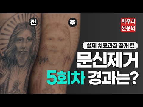 문신 제거 5회차 진행상황은? 잘 지워지는 문신과 잘 안 지워지는 문신의 차이는 뭘까?