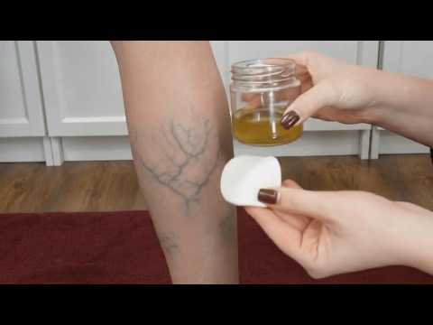 🤯 UNGLAUBLICH! Diese Rosskastaniensalbe lässt Krampfadern verschwinden wie mit einem Radiergummi!